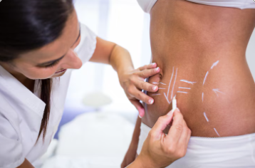 laser-treatment-for-stretch-marks-in-indore